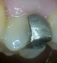Tooth before filling removed
